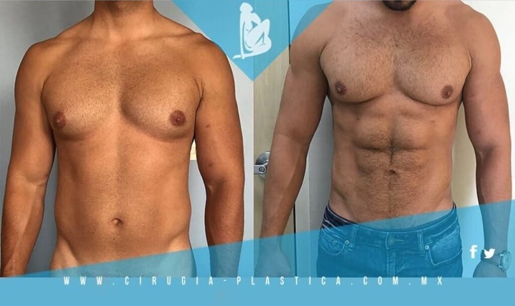 Liposuccion para Hombre CDMX. Dr Christian Morales. Cirujano Plastico Mexico (2)