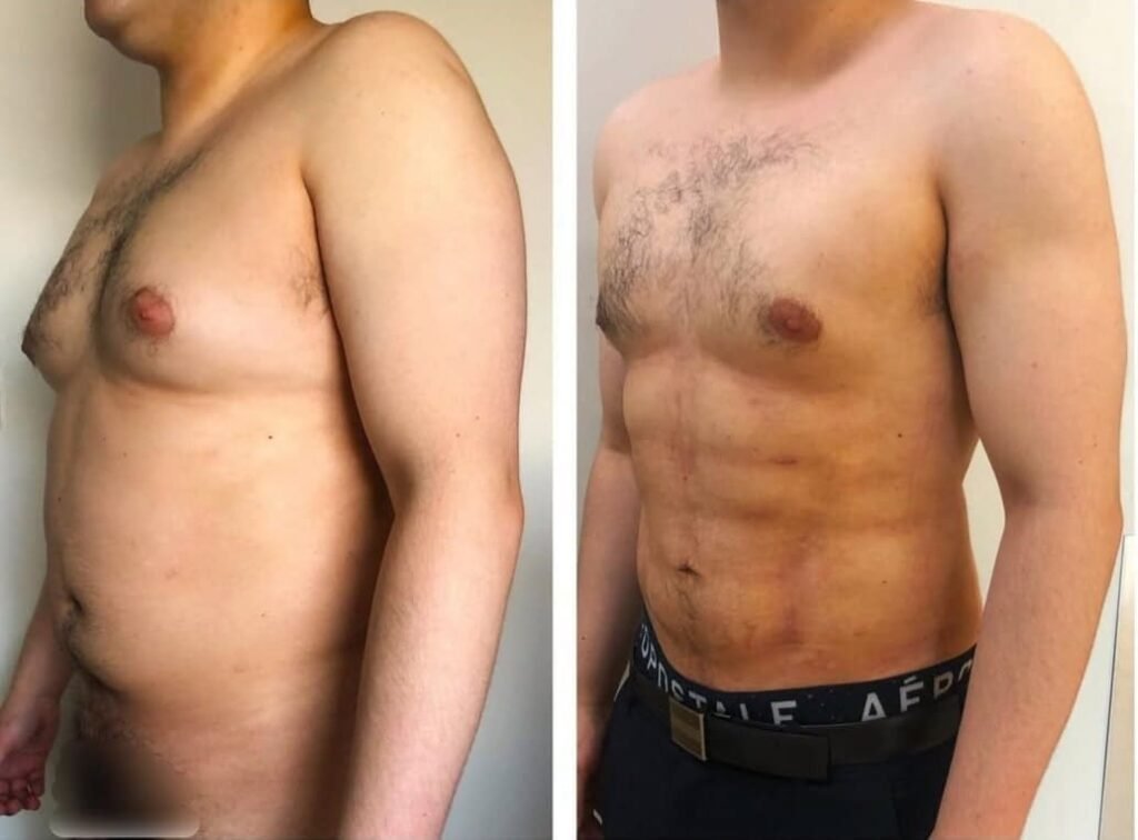 Liposuccion para Hombre CDMX. Dr Christian Morales. Cirujano Plastico Mexico (6)