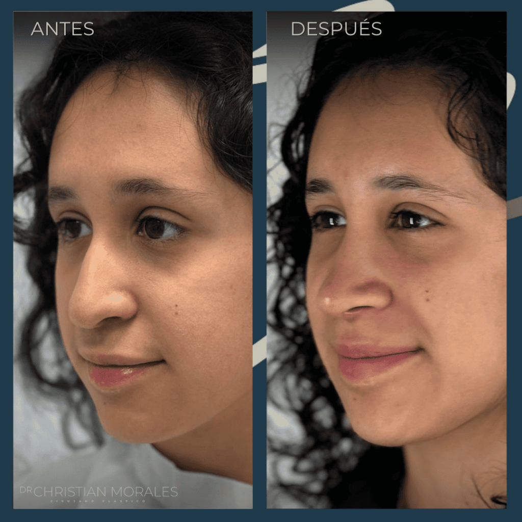 Rinoplastia CDMX. Dr Christian Morales (14)