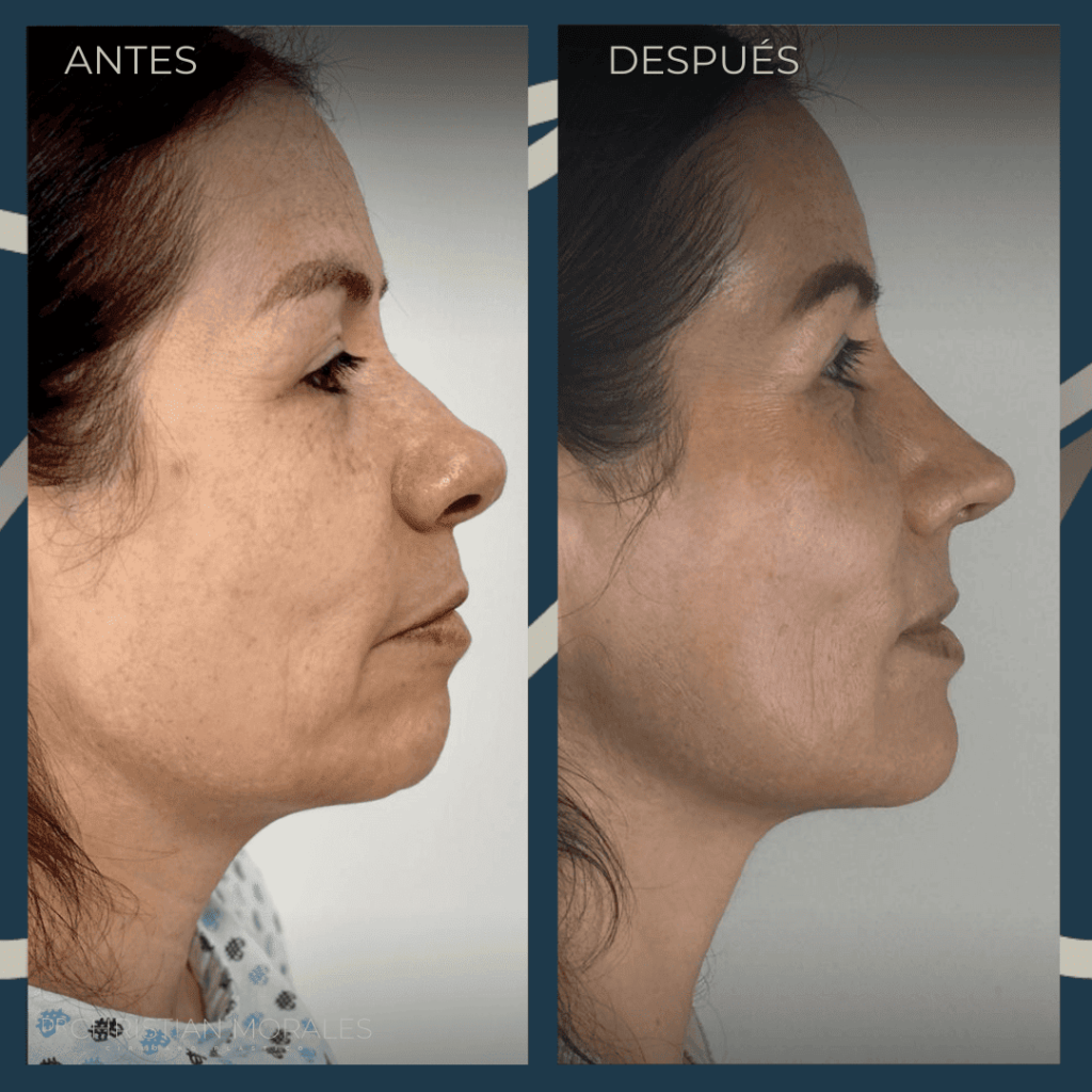 Rinoplastia CDMX. Dr Christian Morales (6)